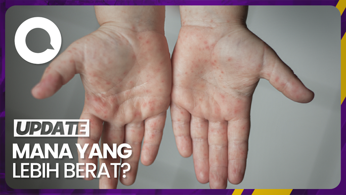 Mengenal Perbedaan Campak dan Rubella