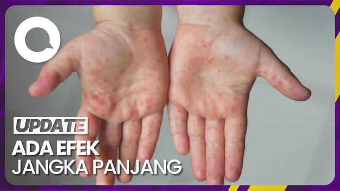 Waspada! Ini Bahaya Campak dan Rubella