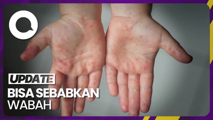 Dokter: Campak 5-10 Kali Lebih Menular dari Covid-19