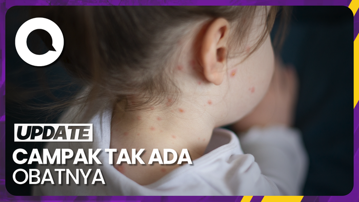Bagaimana Cara Penanganan Campak?