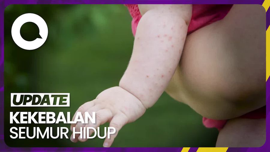 Kalau Sudah Pernah Campak, Bisakah Kena Lagi?