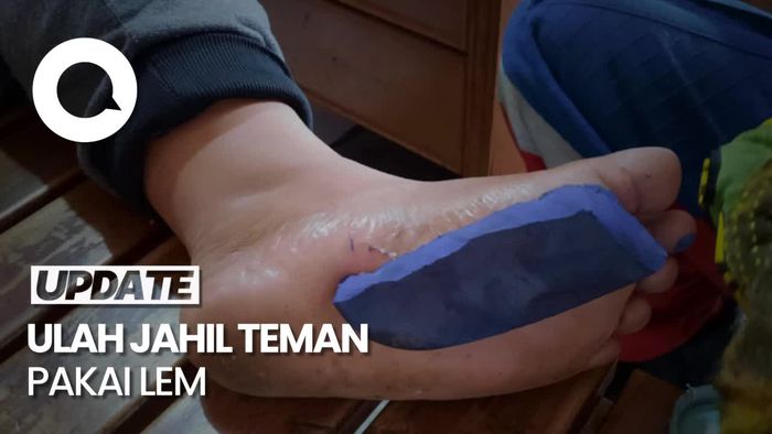 Kaki Bocah di Jaktim Tak Bisa Lepas dari Sandal, Kok Bisa?