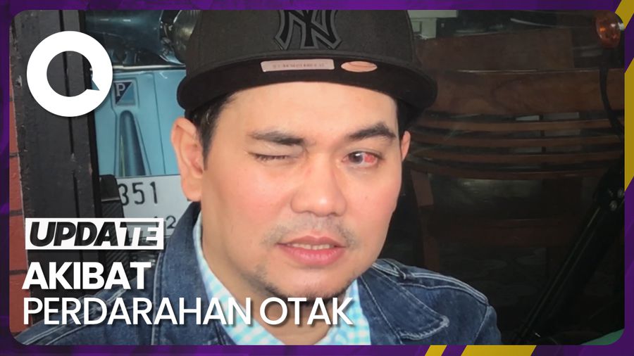 Kondisi Mata Indra Bekti Usai Dioperasi 