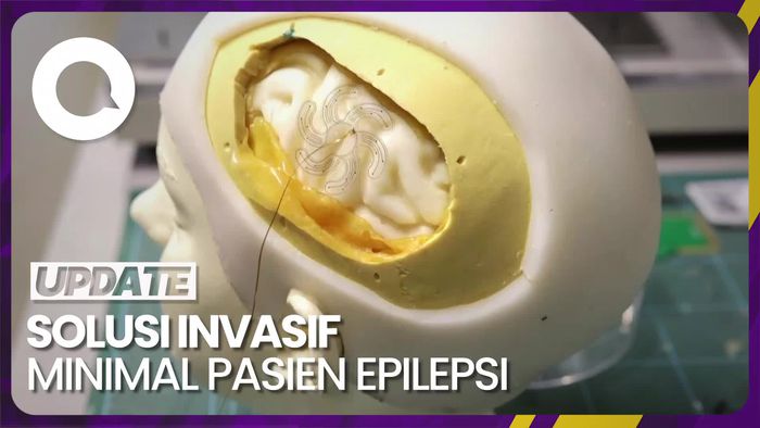 Ilmuwan Swiss Kembangkan Elektroda Lunak untuk Pantau Otak