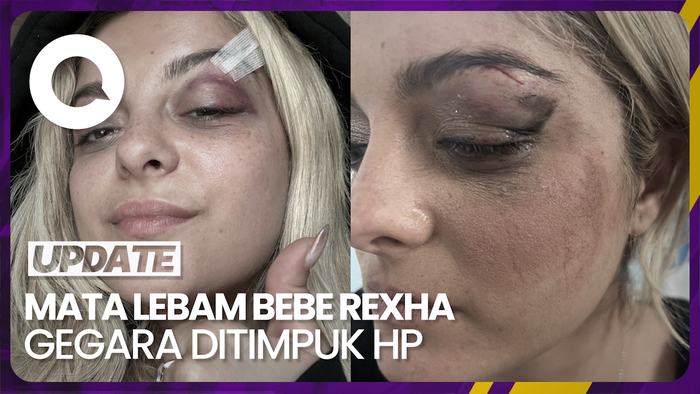 Kondisi Mata Lebam Bebe Rexha Usai Ditimpuk HP Penonton Konser
