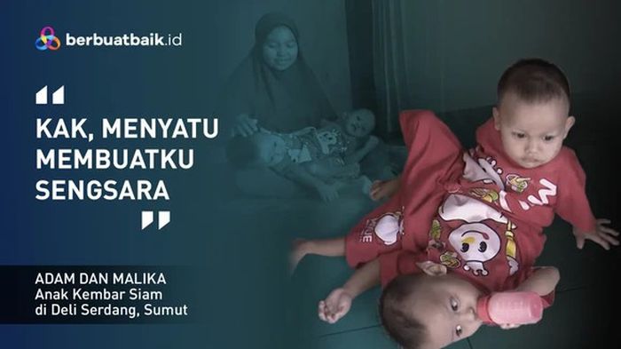 Adam dan Malika, Kembar Siam Berbagi Kaki yang Bergantung pada Ayah Kuli Serabutan