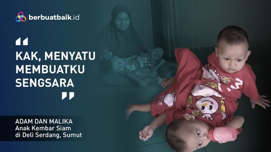 Adam dan Malika, Kembar Siam Berbagi Kaki yang Bergantung pada Ayah Kuli Serabutan