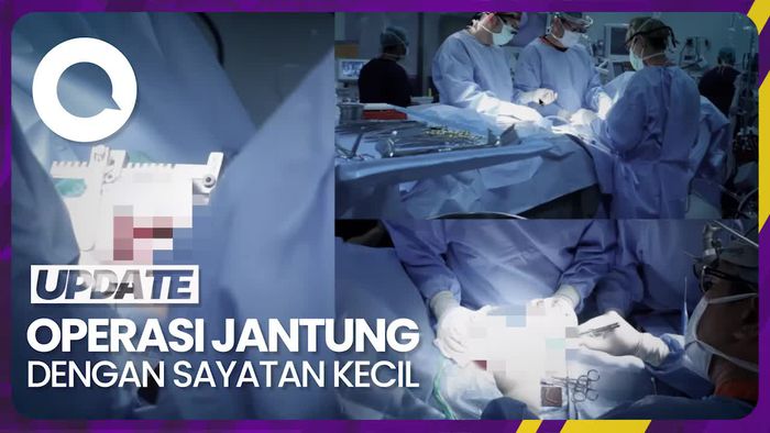 Mengenal MICS, Metode Bedah Jantung yang Minim Sayatan
