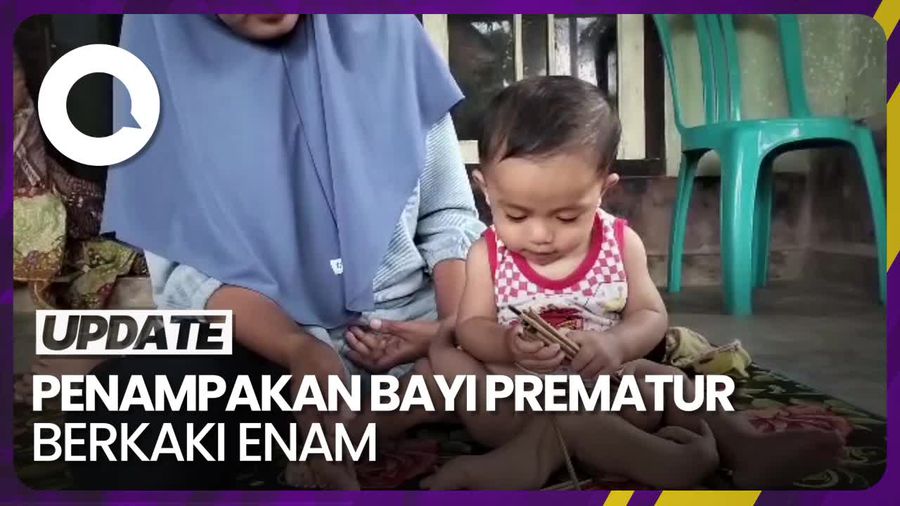Bayi Prematur di Lombok Sekilas Tampak Berkaki Enam