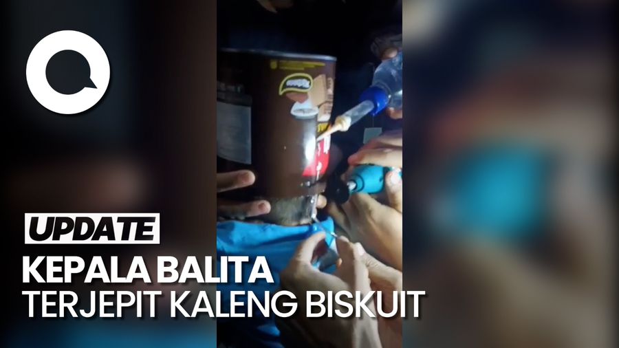 Momen Evakuasi Kaleng Biskuit Tersangkut di Kepala Balita di Tasikmalaya