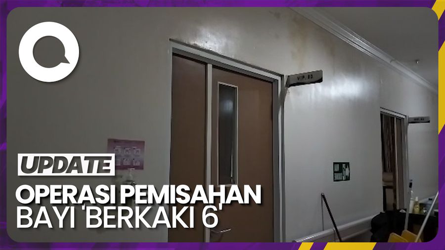 Operasi Pemisahan Bayi Berkaki 6 di Lombok Dilakukan Akhir Pekan