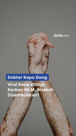 Viral Kena Vitiligo Korban MLM, Bisakah Disembuhkan?