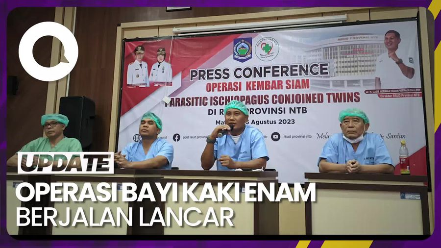 Hasil Operasi Pemisahan Bayi Kaki Enam di RSUP NTB
