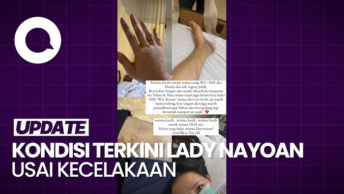 Lady Nayoan Tunjukkan Kaki dan Tangan Penuh Memar Gegara Kecelakaan