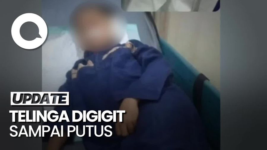 Fakta-fakta Telinga Bocah di Pasuruan Digigit Teman Sampai Putus