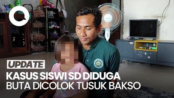 Penjelasan Dokter soal Hasil MRI Mata Siswi SD di Gresik