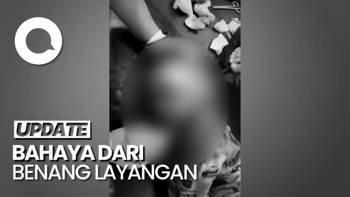 Ngeri, Wajah Bocah Tasikmalaya Terbelah Kena Sayat Benang Layangan