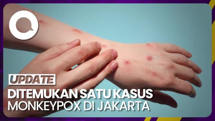 Kemenkes Ungkap Satu Kasus Baru Cacar Monyet di Jakarta