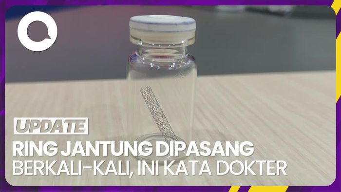 Pemasangan Ring pada Jantung Boleh Dilakukan Berkali-kali