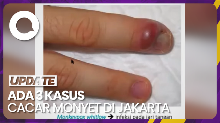 Tambah 1 Kasus Cacar Monyet, Pasien Punya Riwayat Perjalanan 