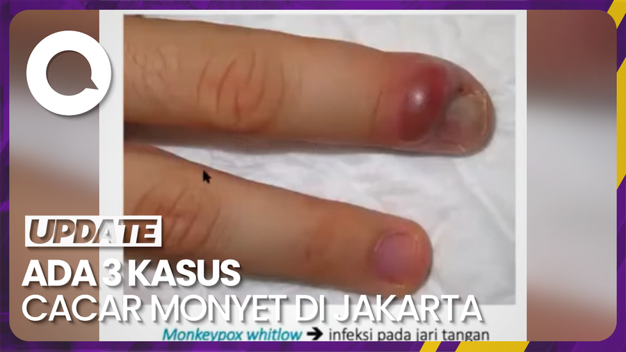 Tambah 1 Kasus Cacar Monyet, Pasien Punya Riwayat Perjalanan 