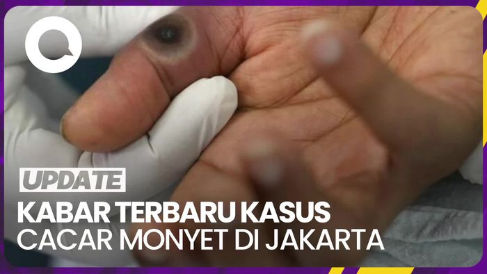 Update Kasus Cacar Monyet di Jakarta, Gejala hingga Prioritas Vaksin