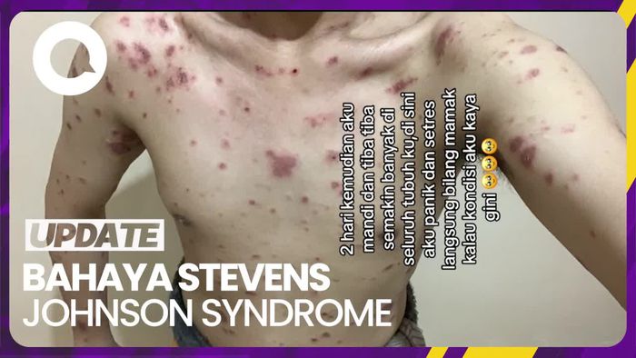 Penyakit Kulit Stevens Johnson Syndrome Mampu Lukai Organ Dalam