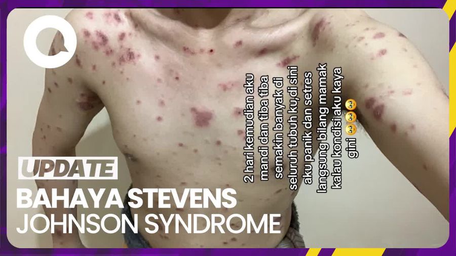 Penyakit Kulit Stevens Johnson Syndrome Mampu Lukai Organ Dalam