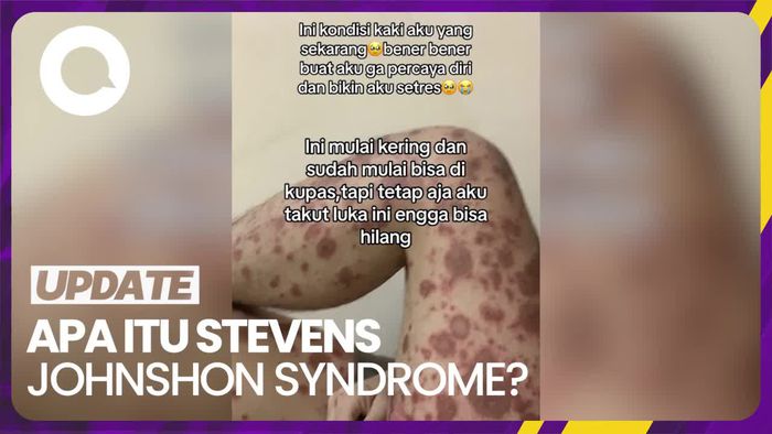 Mengenal Penyakit Kulit Stevens Johnson Syndrome 