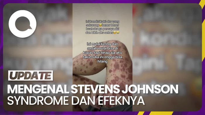 Stevens Johnson Syndrome, Penyakit Kulit yang Tergolong Berbahaya