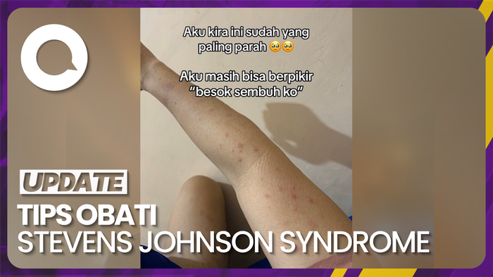 Cara Sembuhkan Penyakit Kulit Stevens Johnson Syndrome 