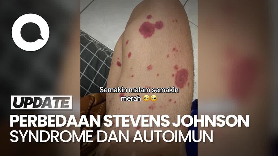 Pakar Sebut Stevens Johnson Syndrome Tak Sama Dengan Autoimun
