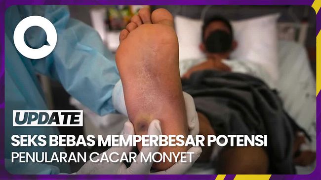 Mengapa Mayoritas Penderita Cacar Monyet Ada Riwayat HIV? Kemenkes Membuka Rahasia
