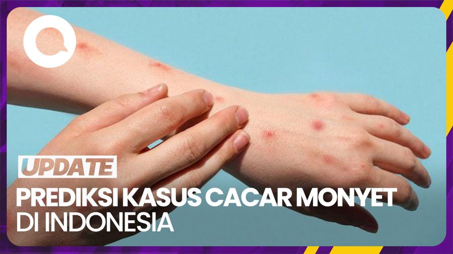 Cacar Monyet RI Diprediksi Bisa Tembus 3.600 Kasus, Jika...