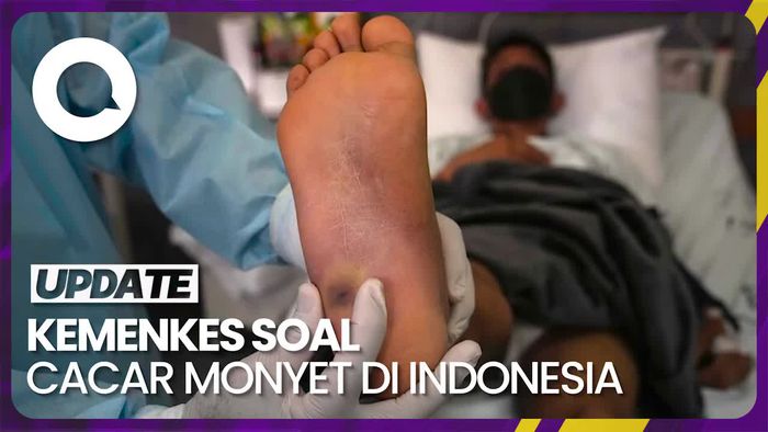 Kemenkes Bicara Cacar Monyet di RI, Prediksi Bisa Tembus 3.600 Kasus