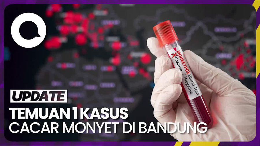 1 Kasus Cacar Monyet Ditemukan di Bandung