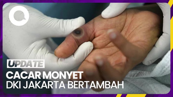 Nambah Lagi! Pasien Cacar Monyet Aktif di DKI Jakarta Kini 24 Orang