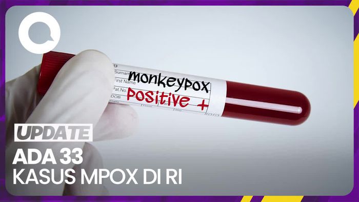  1 Pasien Baru Mpox Domisili Bekasi, Total 33 Kasus di RI