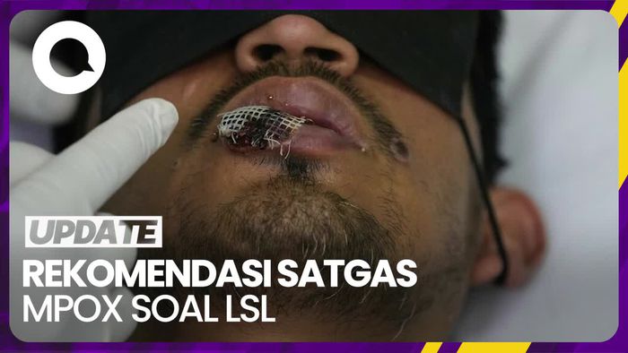 Catat! Ini yang Perlu Dilakukan untuk Tekan Kasus Mpox karena LSL