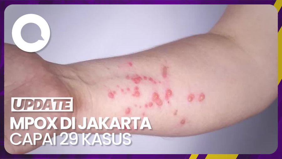 Satgas Mpox Sebut 90% Pasien di Jakarta Tertular karena LSL, Apa Itu?
