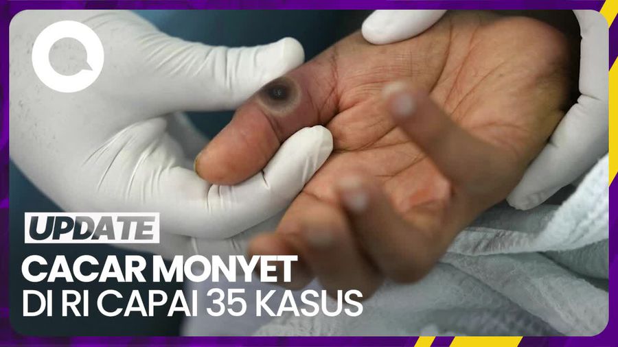 Kasus Cacar Monyet Meningkat, Penularan Terbanyak karena Ini