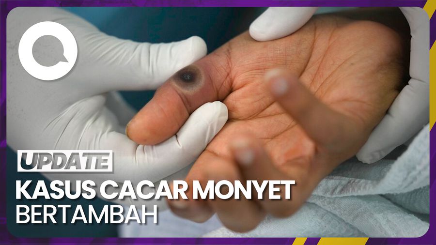 Total Kasus Cacar Monyet di Indonesia Jadi 44 Orang