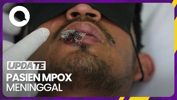 Satu Pasien Mpox Dilaporkan Meninggal Karena HIV