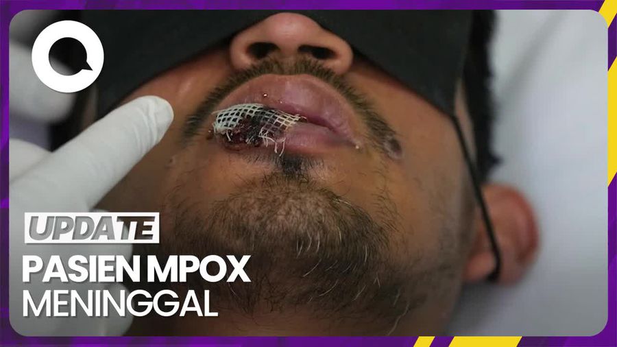 Satu Pasien Mpox Dilaporkan Meninggal Karena HIV