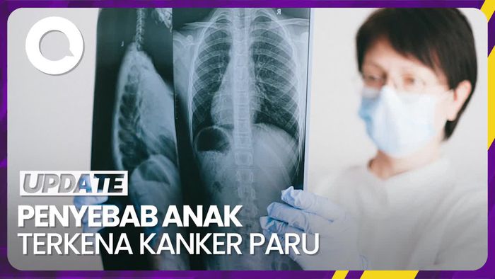 Anak Usia 9 Tahun Terkena Kanker Paru gegara Perokok Pasif