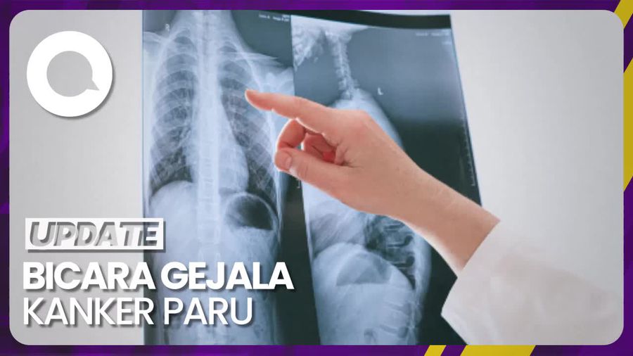 Dokter: Kanker Paru Banyak yang Tak Bergejala 