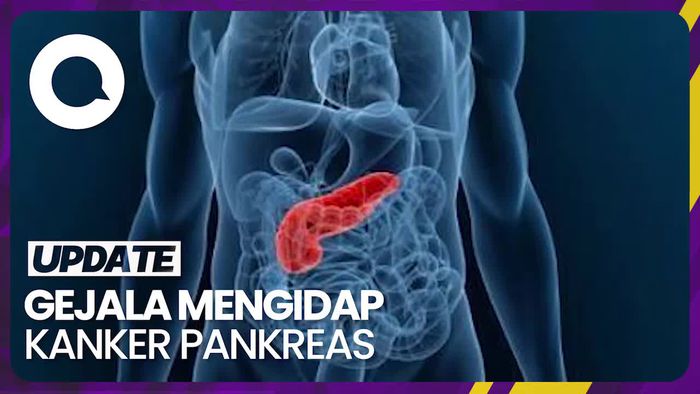 Tanda-tanda Seseorang Mengidap Penyakit Kanker Pankreas