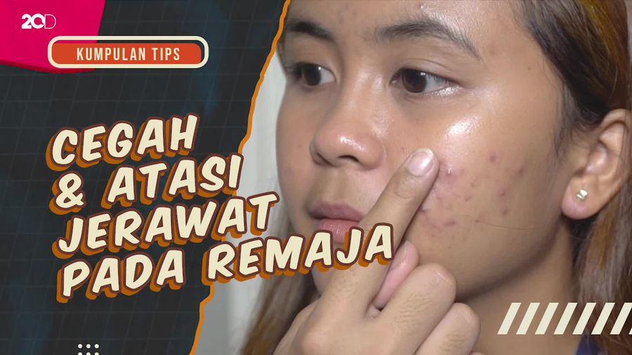 KuTips: 3 Saran Dokter Kulit untuk Obati Jerawat pada Remaja