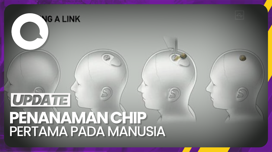 Neuralink Milik Elon Musk Berhasil Tanam Chip ke Manusia