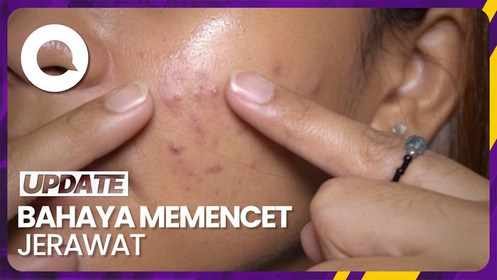 Bahaya yang Mengintai Jika Pencet Jerawat, Bisa Berujung Kematian
